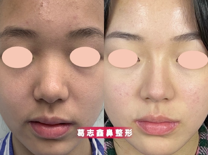 上海葛志鑫做鼻子怎么樣