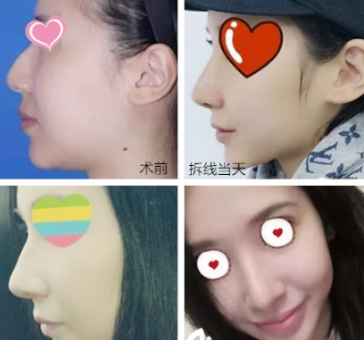 上海九院鼻修復李青峰和戴傳昌哪個好