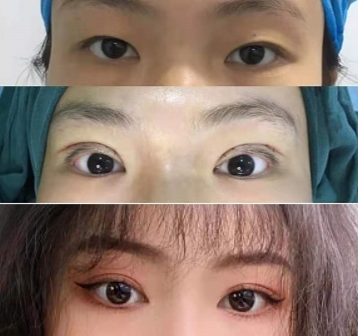 西京宋寶強做雙眼皮修復(fù)怎么樣