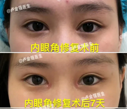 盧金強內眼角修復案例