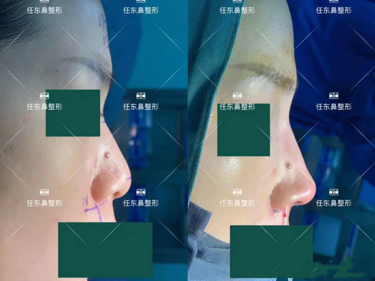 杭州任東做鼻子怎么樣
