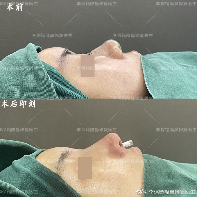 杭州隆鼻哪個(gè)醫(yī)生比較好