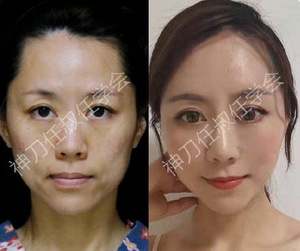 任學會面部填充案例