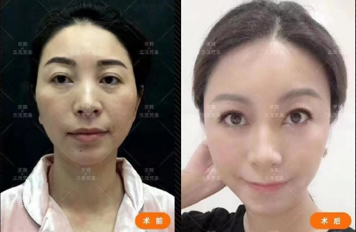喬愛軍脂肪填充案例