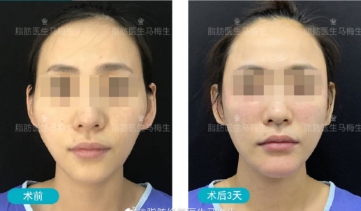 馬梅生脂肪填充案例