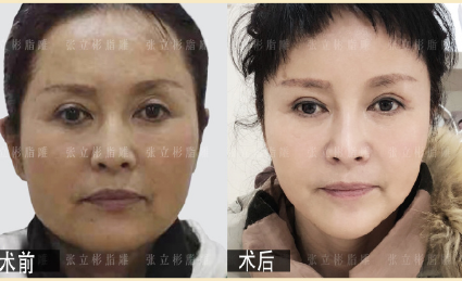 張立彬脂肪填充案例