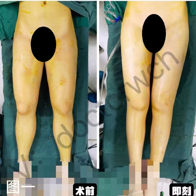 北京八大處吸脂哪個醫(yī)生好