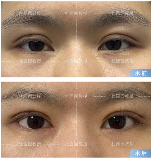 杜園園內(nèi)眼角修復(fù)案例