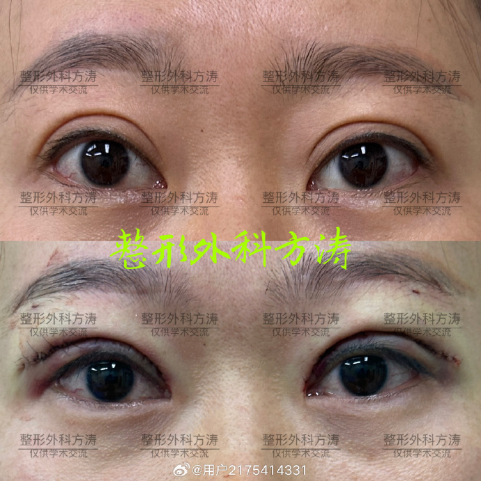 方濤雙眼皮修復(fù)案例