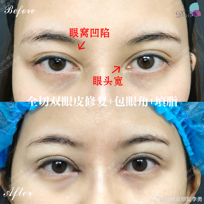李勇雙眼皮修復(fù)案例