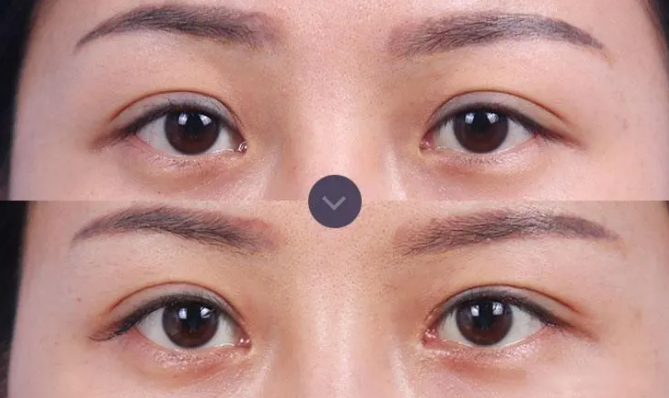 北京雙眼皮修復最厲害醫生是哪個?