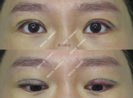 北京雙眼皮修復(fù)醫(yī)生王成源、王維、朱曉峰哪個(gè)好？