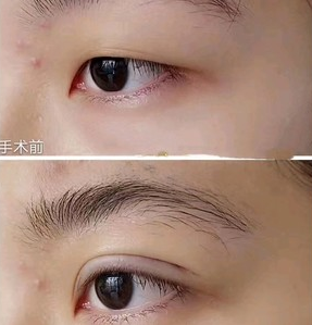 沈陽楊慶峰雙眼皮修復技術怎么樣