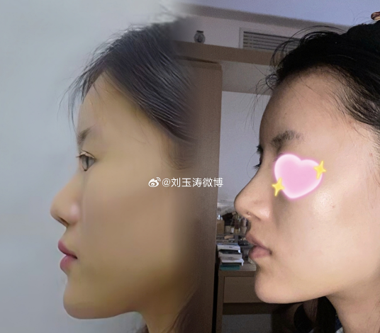 劉玉濤鼻修復案例