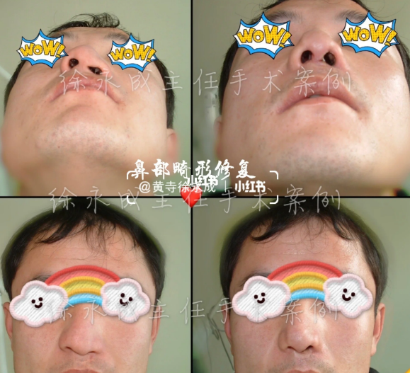 徐永成鼻修復案例
