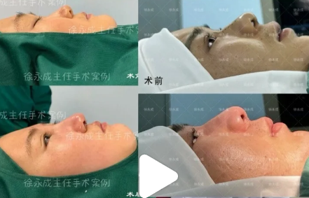 徐永成鼻修復(fù)案例