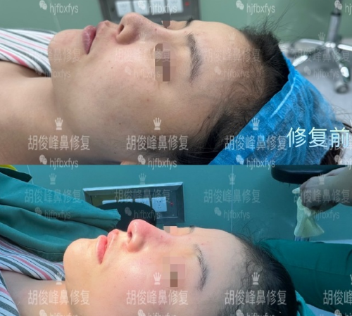 胡俊峰鼻修復(fù)案例