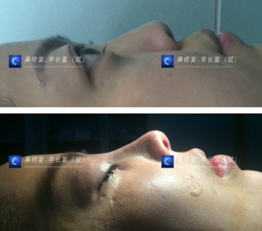 李長富鼻修復(fù)案例