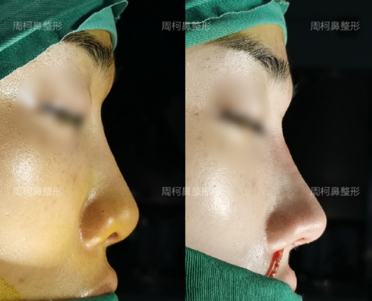 成都鼻修復哪個醫生技術好？周柯、倪云志、韓國棟？