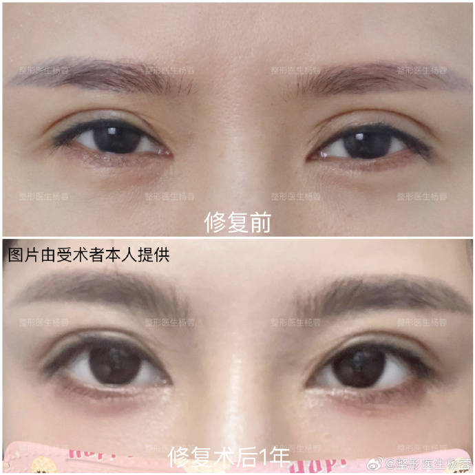 楊蓉雙眼皮修復(fù)案例