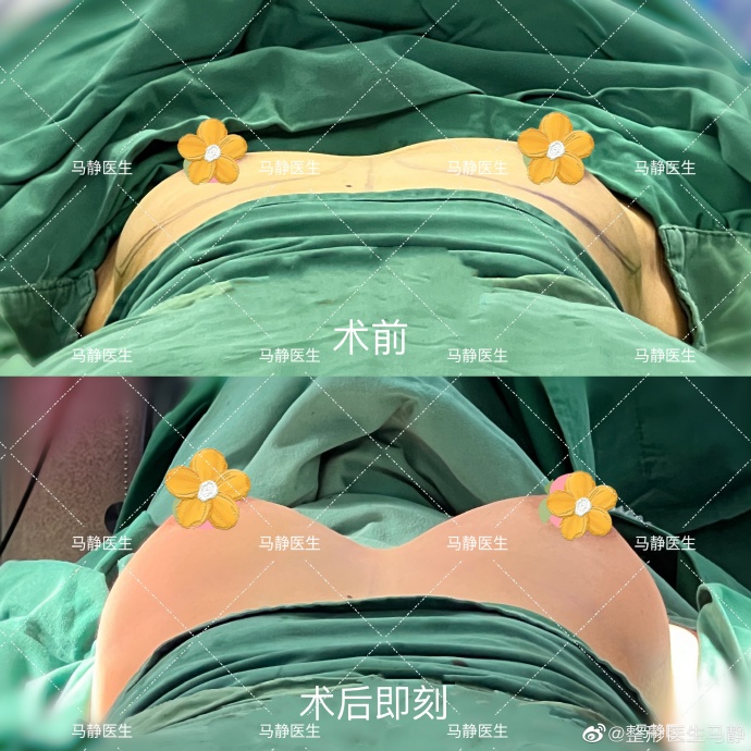 馬靜假體豐胸案例