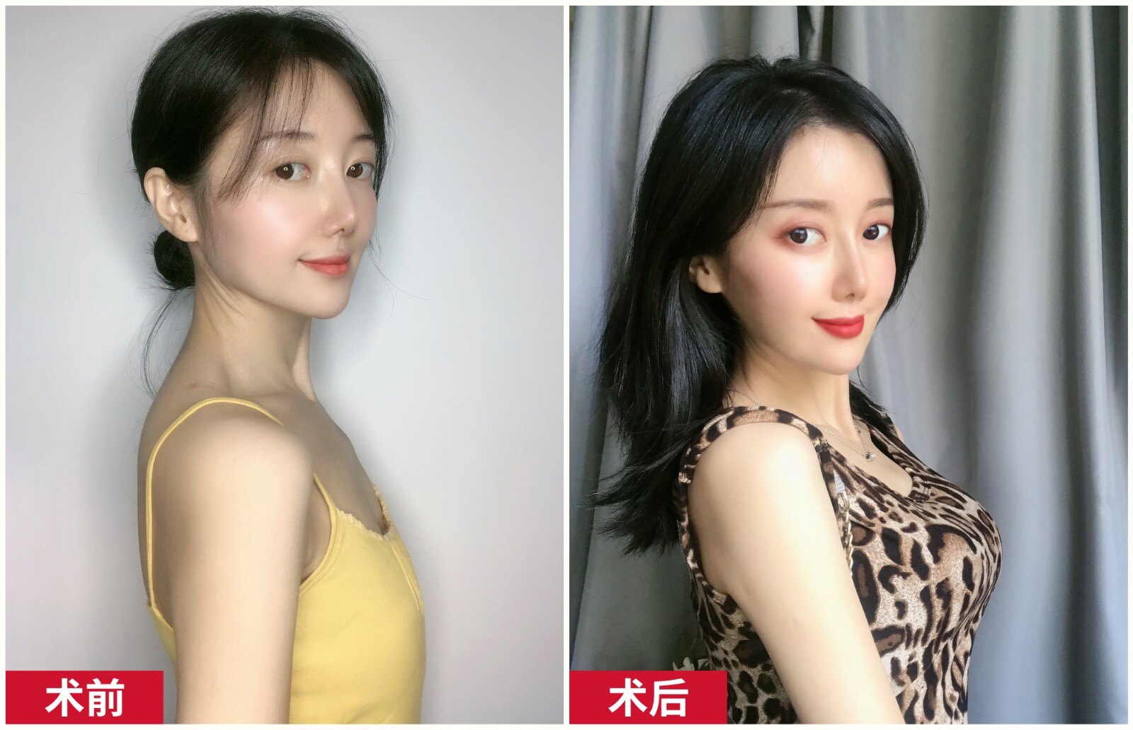 欒杰做假體豐胸案例