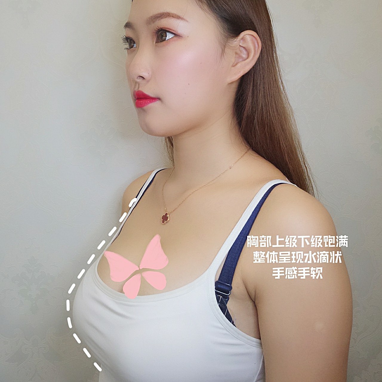 北京八大處欒杰做假體豐胸貴嗎？