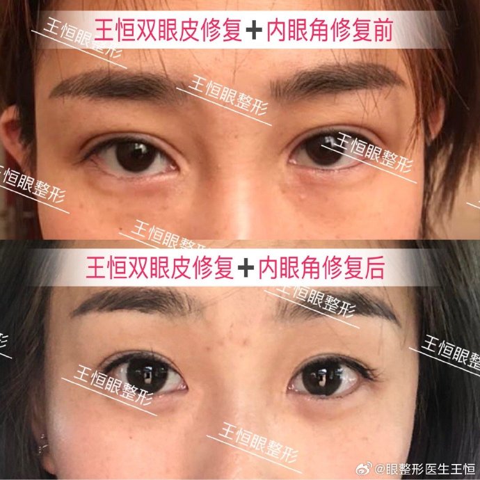 王恒內(nèi)眼角修復(fù)案例