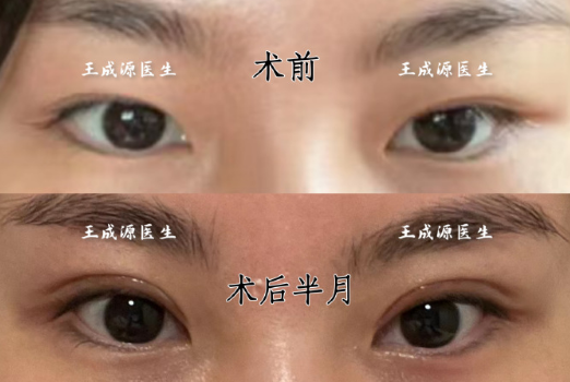 王成源雙眼皮修復案例