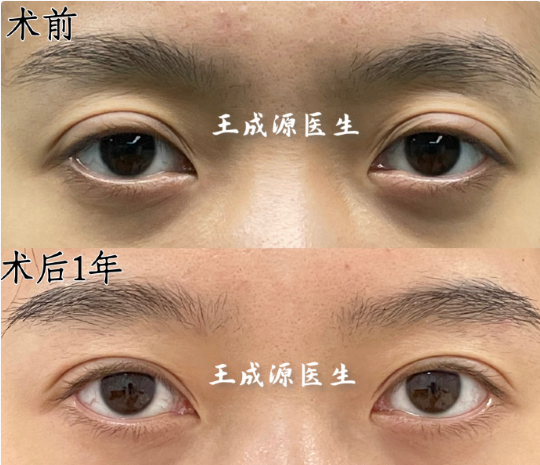 王成源雙眼皮修復案例