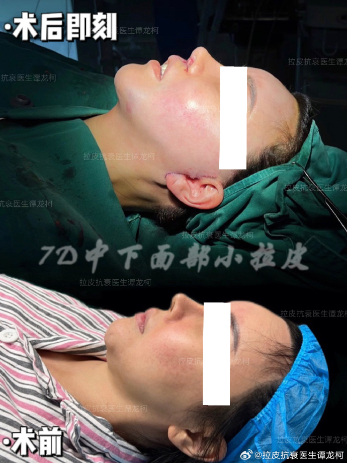 譚龍柯面部拉皮案例