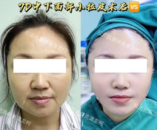 譚龍柯面部拉皮案例