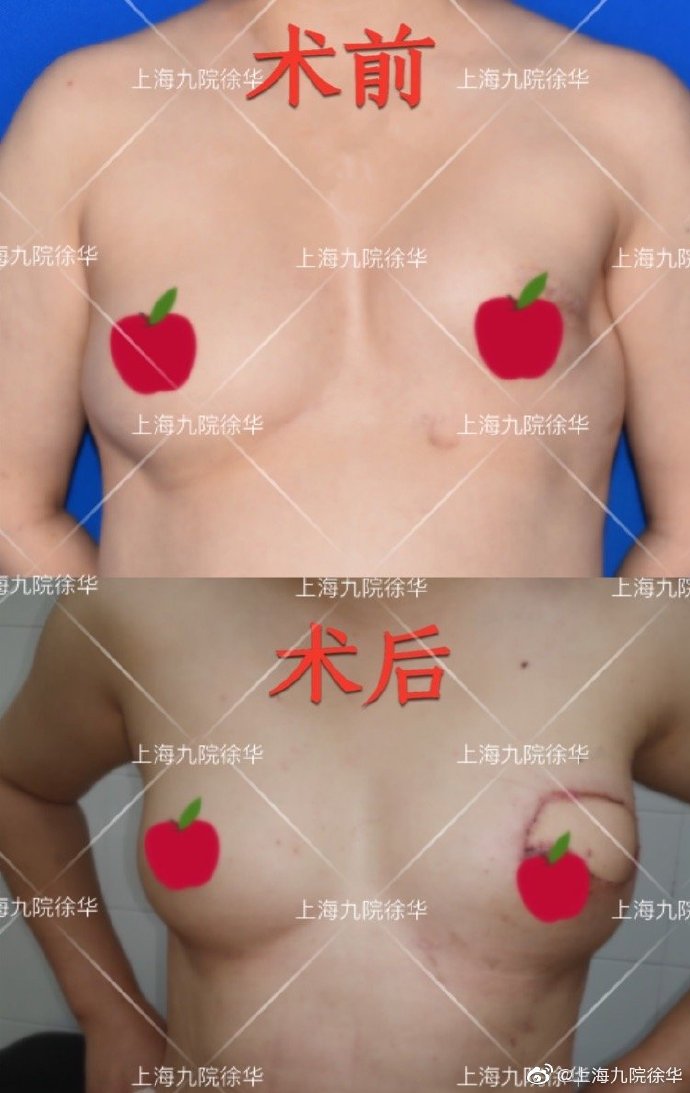徐華乳房再造案例