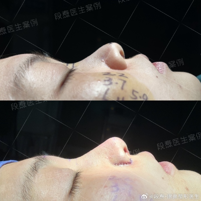 段醫生鼻綜合案例