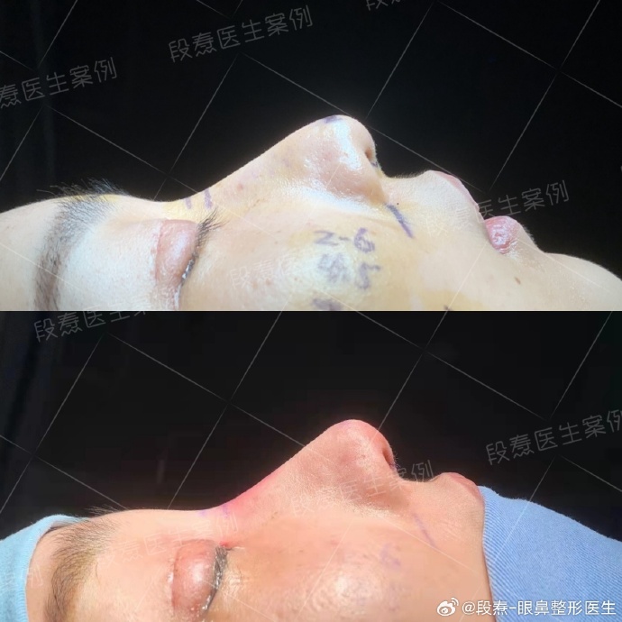 段醫生鼻修復案例