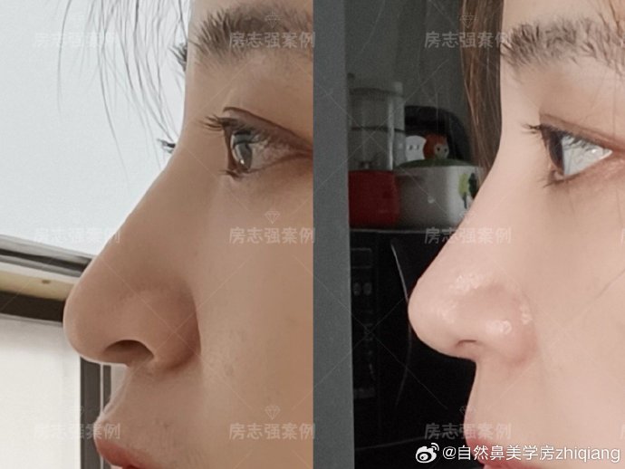 房志強鼻綜合案例