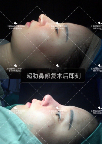李哲權鼻綜合案例