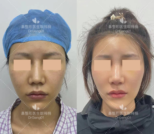 耿祎楠鼻修復案例