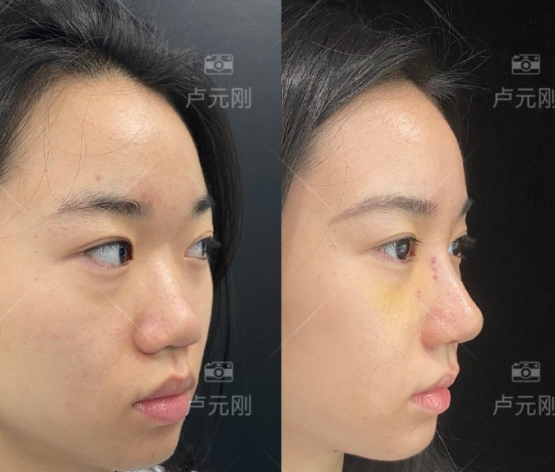 成都哪個鼻子做的好？盧元剛、黃開亮、卿勇、倪云志、鄧東偉？