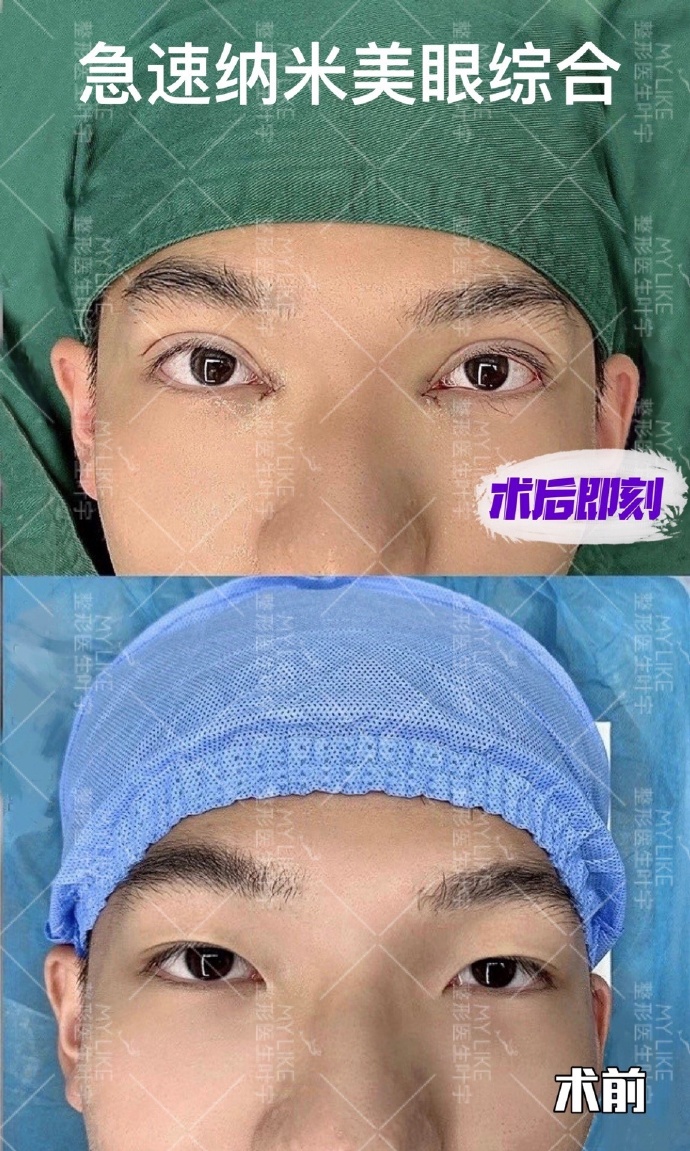 葉宇雙眼皮案例