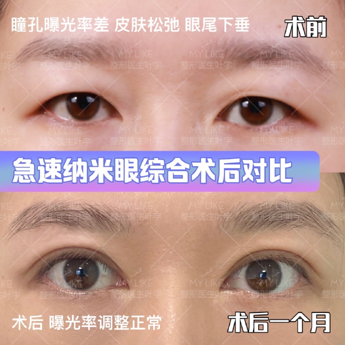 葉宇眼綜合案例
