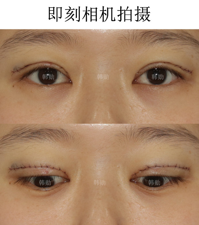 國內比較火的雙眼皮醫生和雙眼皮修復醫生