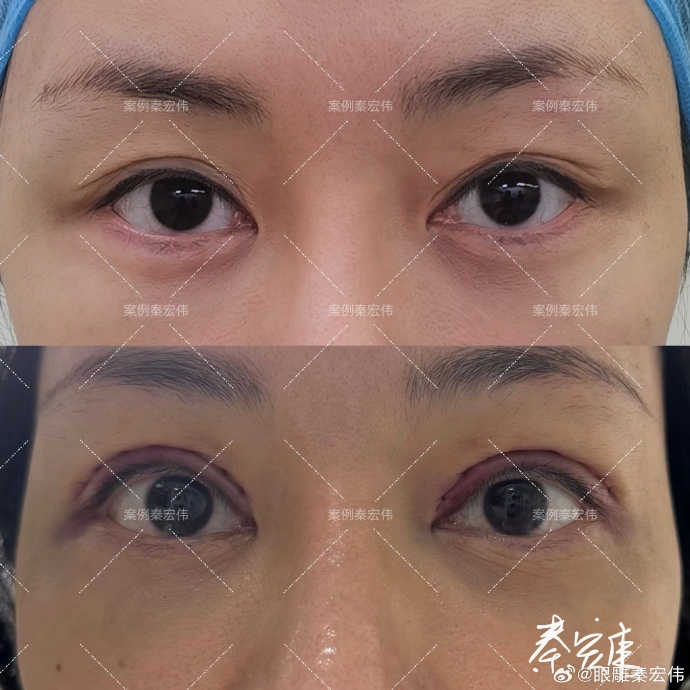 秦宏偉眼修復案例
