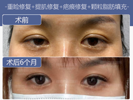 周瑜雙眼皮修復(fù)案例
