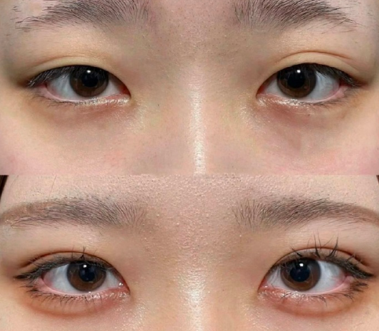 李秋月雙眼皮案例
