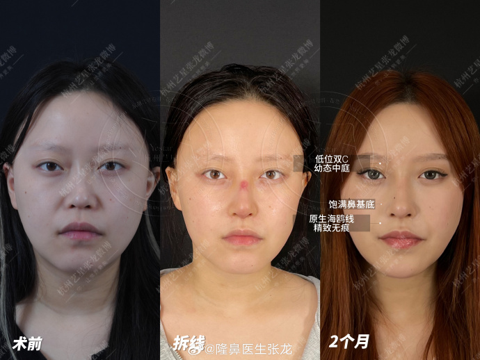 杭州鼻修復張龍和任東哪個好？