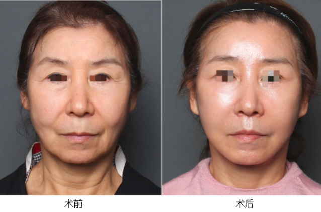 北京拉皮手術(shù)最好的醫(yī)生是哪個？祝東升、趙延勇、張海明、謝宏彬？