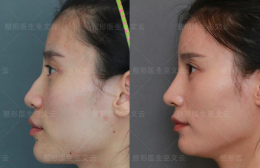 巫文云鼻修復(fù)案例