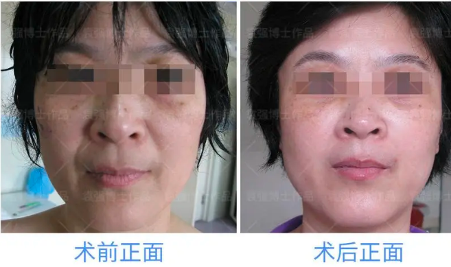北京拉皮袁強和張海明哪個醫生好