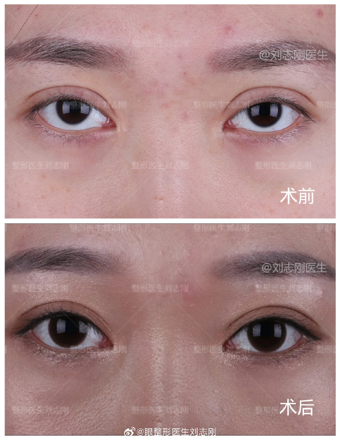 劉志剛雙眼皮修復(fù)案例